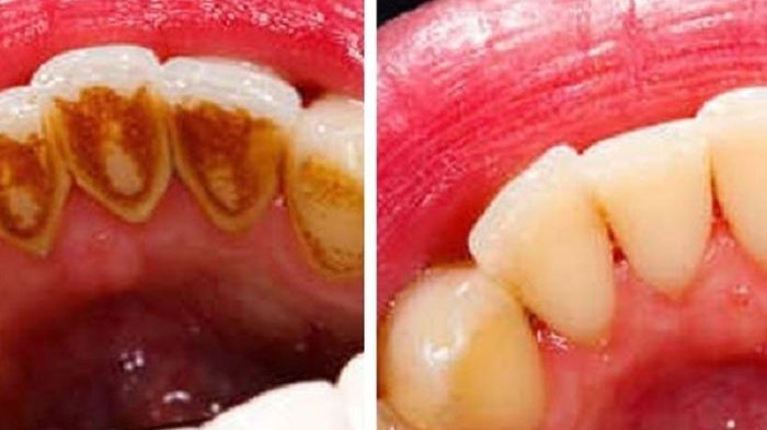 Inilah Penyebab Karang Gigi Yang Muncul Akibat Kebiasaan Tidak Baik!